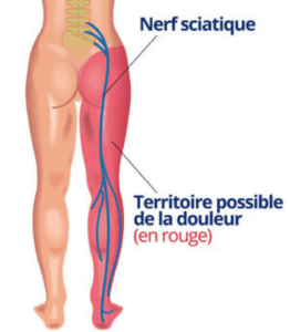 nez sciatique